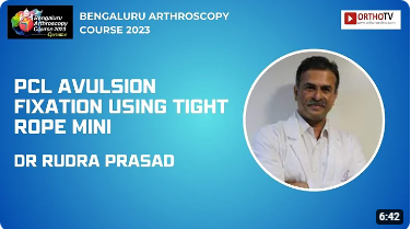 Thumbnail of Dr Rudraprasad's talk on PCL AVULSION FIXATION USING TIGHT ROPE MINI